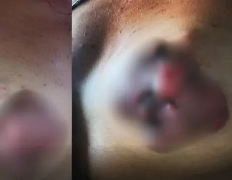 Mulher com câncer de mama grave aguarda atendimento pelo SUS desde novembro e família cobra urgência em Maceió